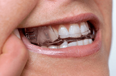 Oral appliance for treating sleep apnea shown in a patient's mouth